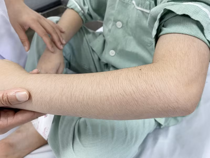 Lạm dụng thuốc xịt mũi, hai anh em bị suy tuyến thượng thận -0