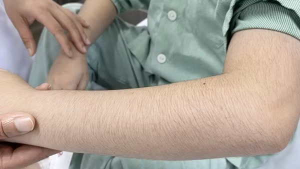 Lạm dụng thuốc xịt mũi, 2 anh em bị suy thượng thận