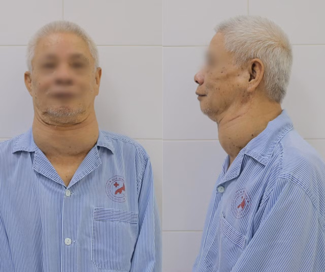 Cụ ông mang khối bướu khổng lồ suốt nhiều năm -0