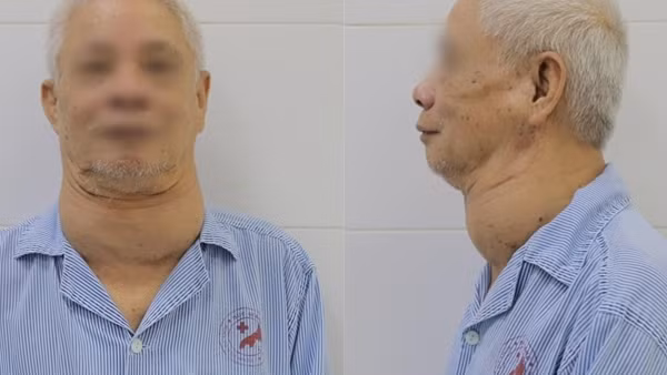 Phẫu thuật cho cụ ông mang khối bướu khổng lồ suốt nhiều năm