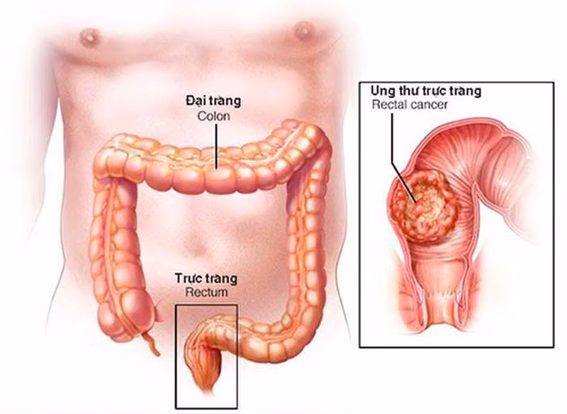 15 tuổi đã mắc ung thư đại trực tràng, bác sĩ cảnh báo bệnh ngày càng trẻ hoá -0