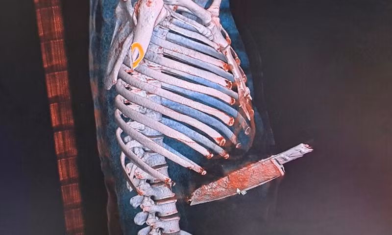 Mẫu thuẫn cá nhân dùng dao đâm thủng bụng bạn nhậu -0