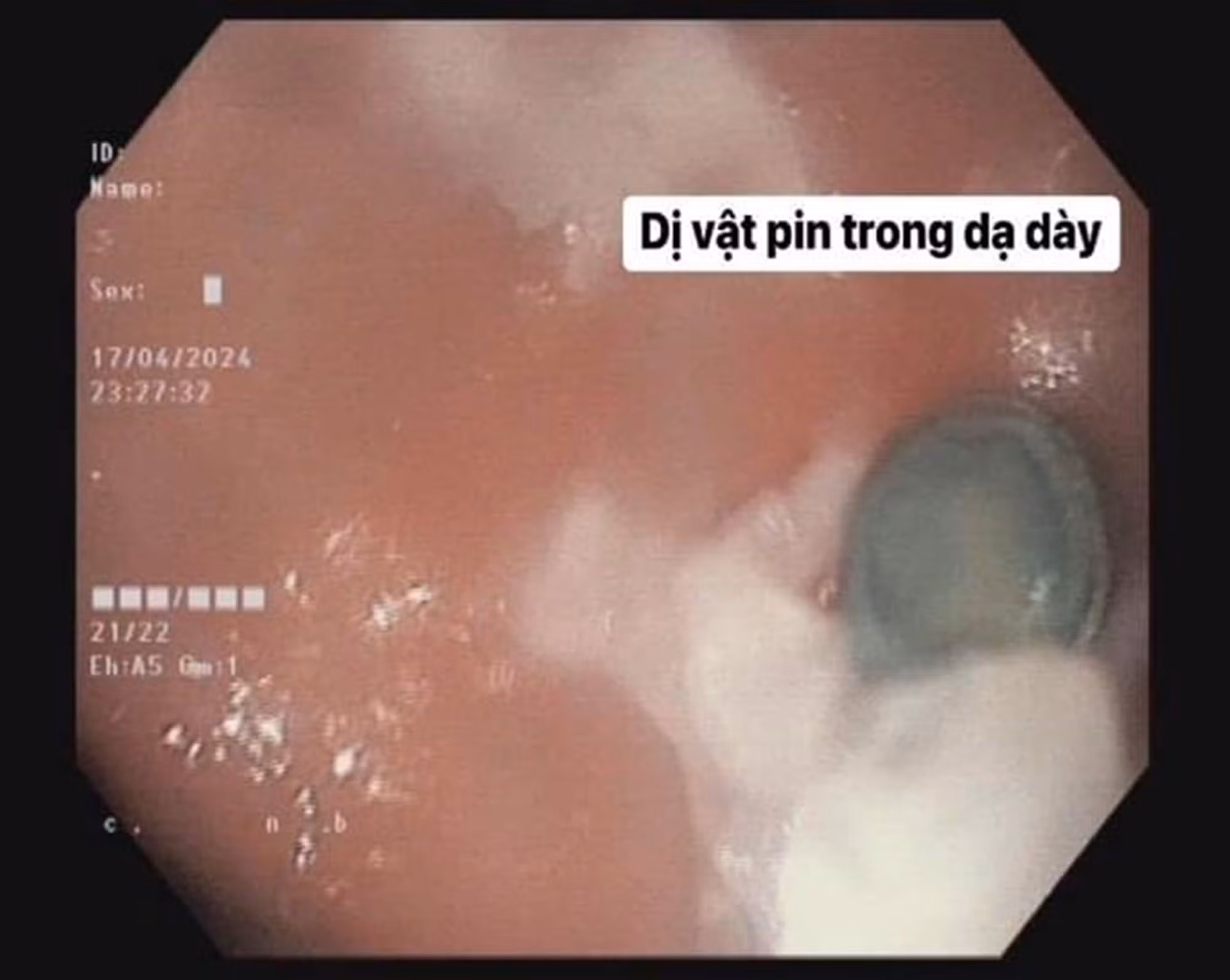 Rùng mình những dị vật trẻ em nuốt phải -0
