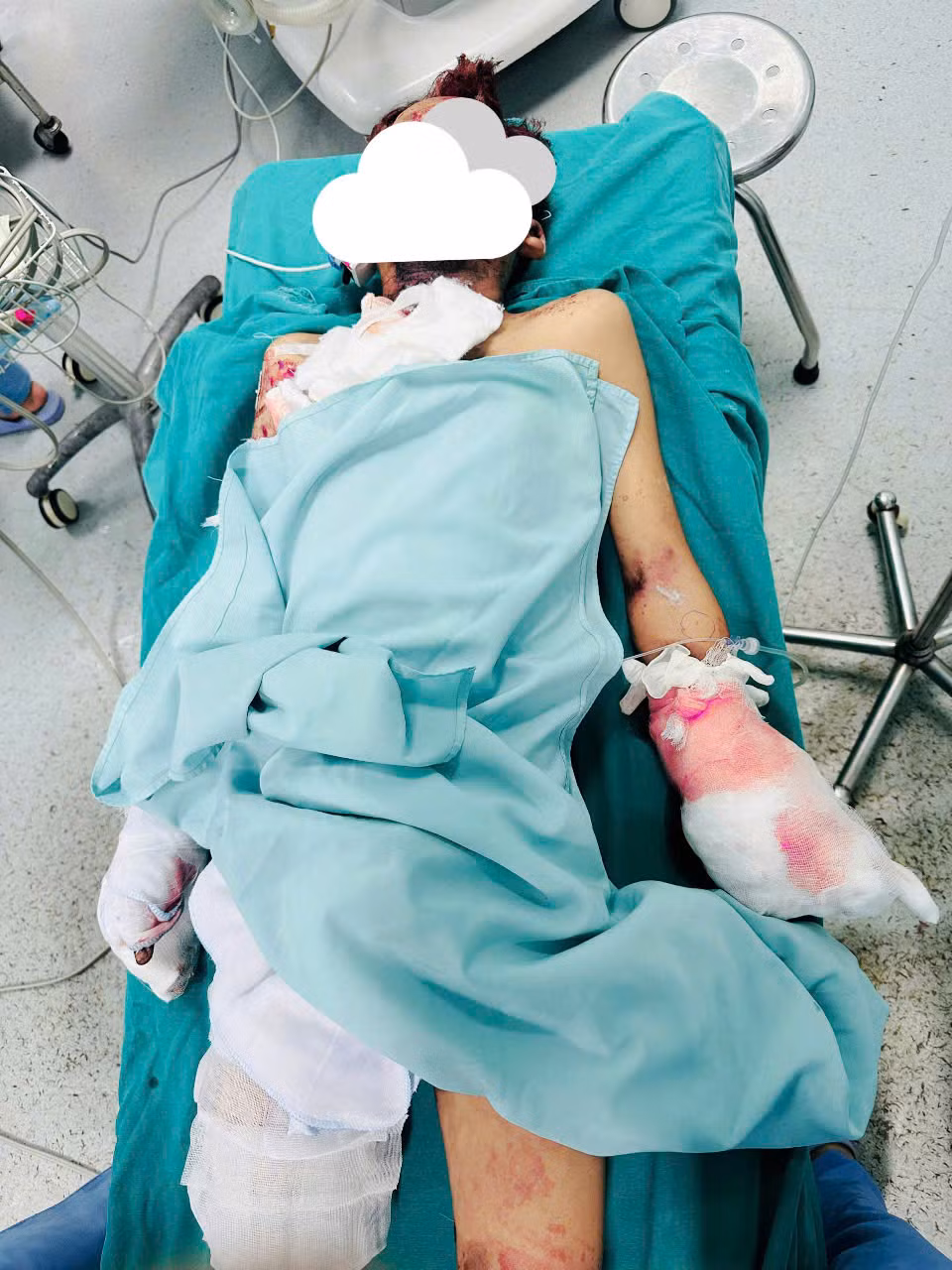 Một học sinh lớp 6 ở Thanh Hoá nát bàn tay vì nổ pháo -0