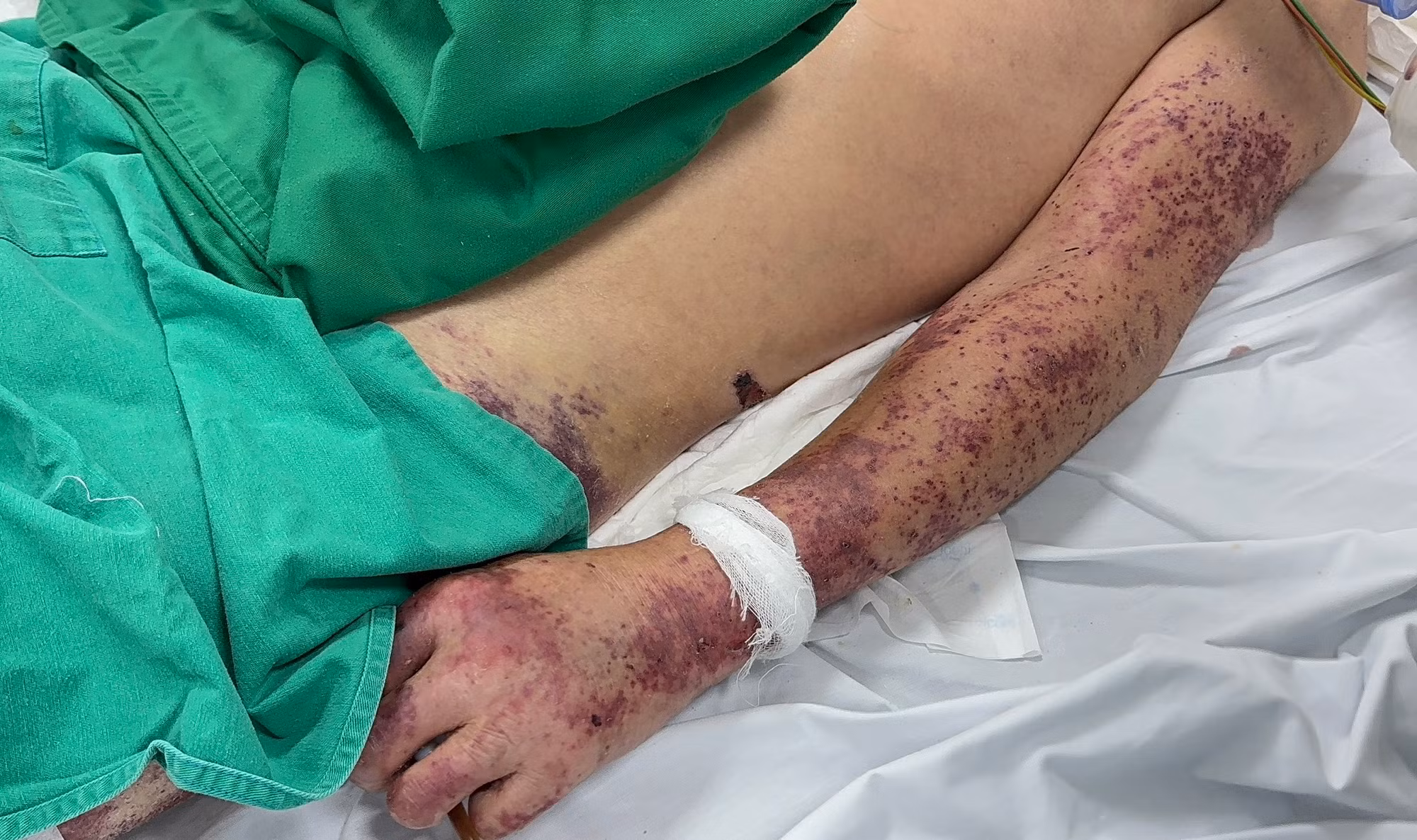 Mua thủ lợn về chế biến, người đàn ông mắc liên cầu nguy kịch -0