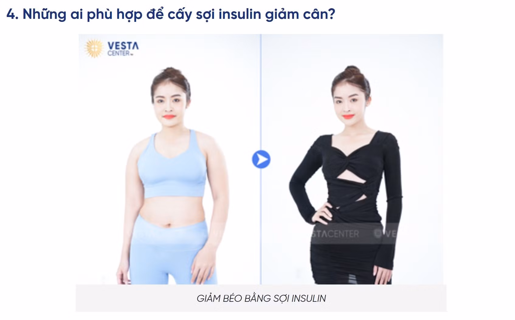 Dịch vụ cấy vi sợi sinh học Insulin để giảm béo là không có căn cứ khoa học -0