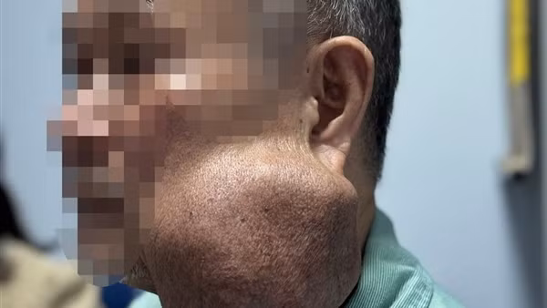Suýt mất mạng vì mang khối u khổng lồ 30 năm không điều trị