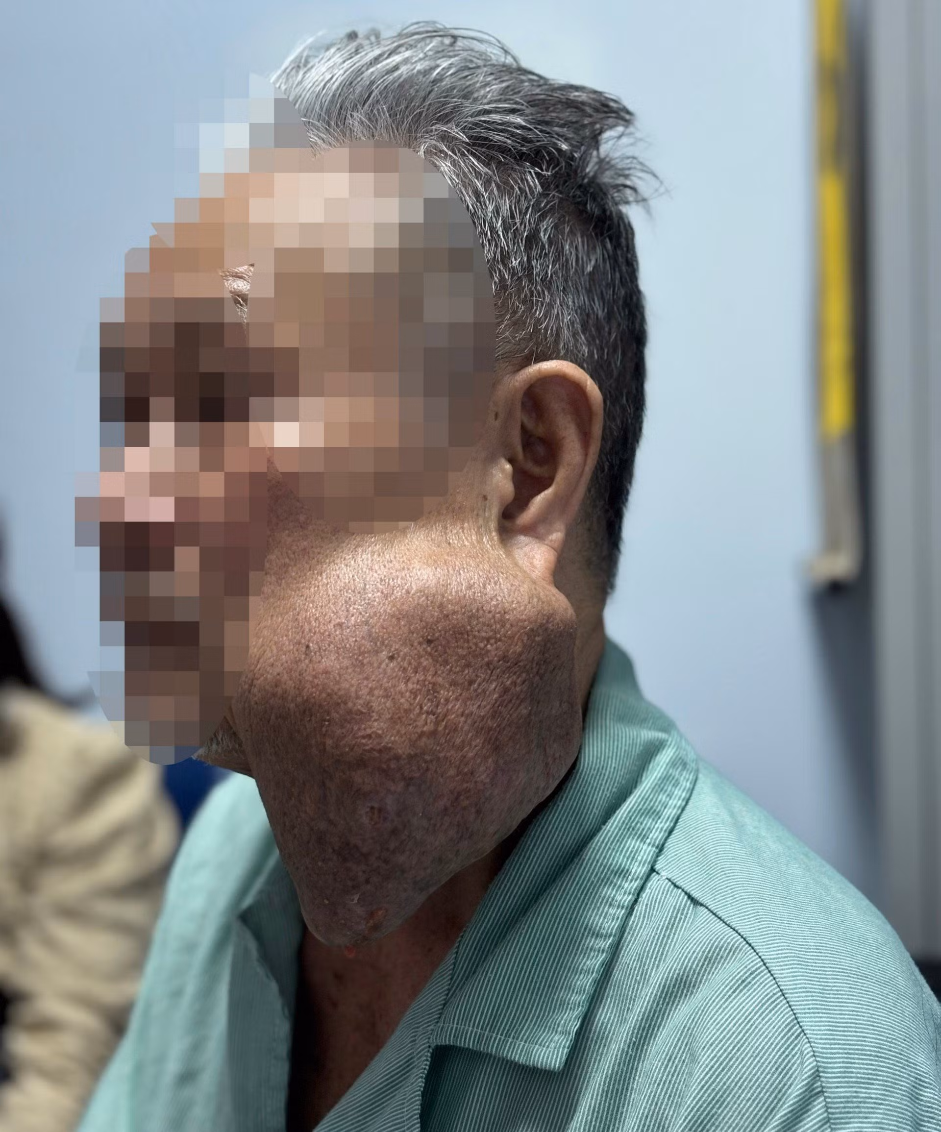 Suýt mất mạng vì mang khối u khổng lồ 30 năm không điều trị -0