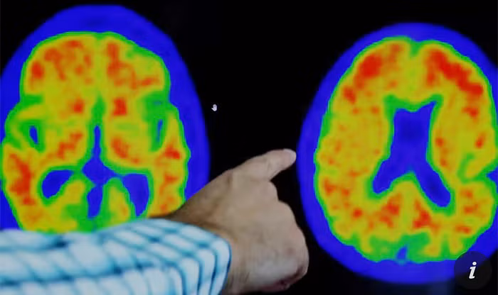 Thuốc mới mang đến hi vọng chữa bệnh Alzheimer từ năm 2024 -0