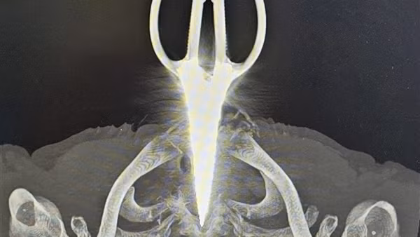 Cứu sống bệnh nhân cầm kéo tự đâm xuyên cổ