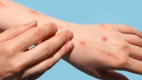 Phát hiện 2 bệnh nhân HIV nhiễm đậu mùa khỉ
