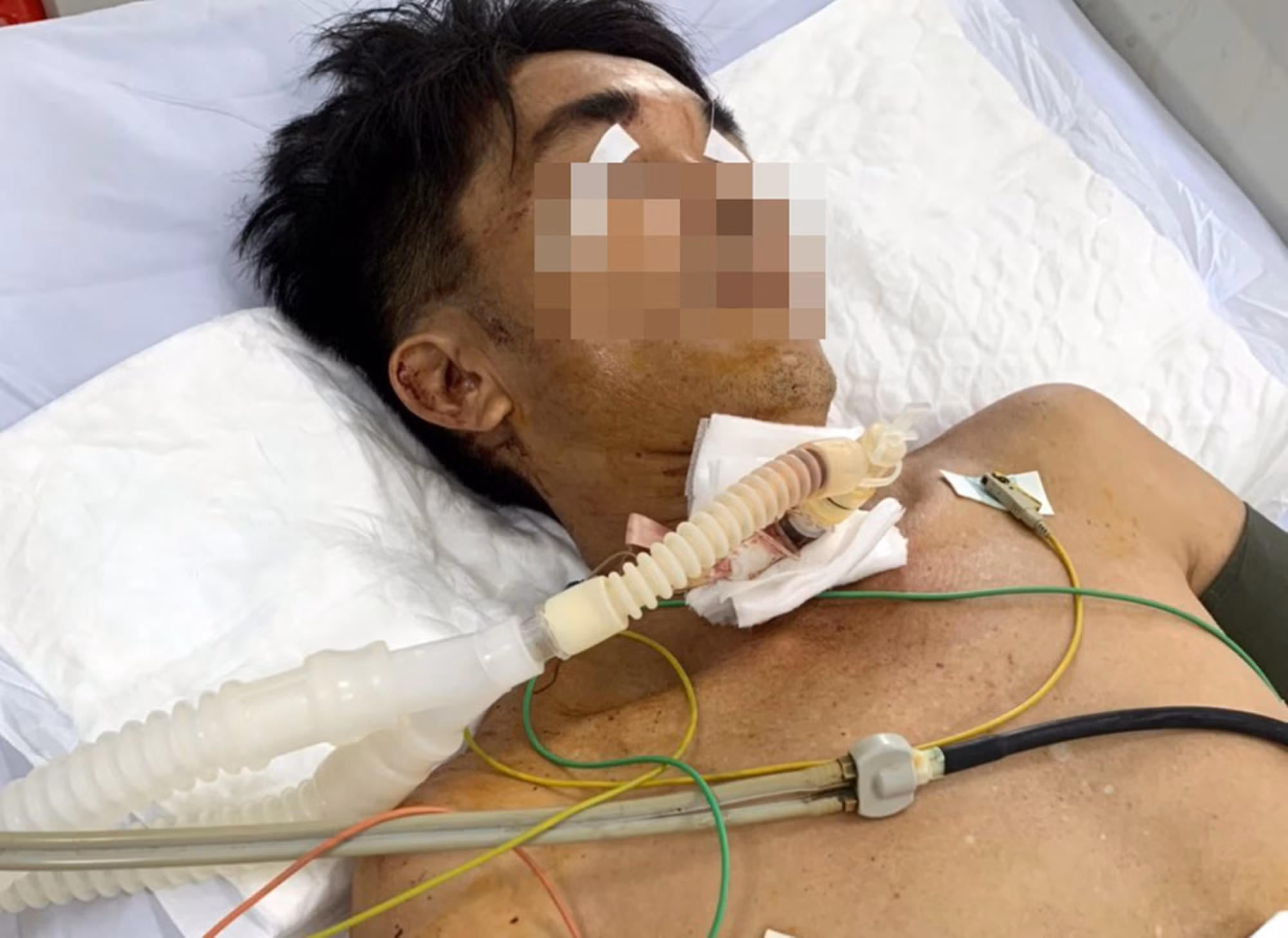 Cứu kịp thời người đàn ông dùng dao đâm vào bụng, cắt cổ tự sát -0