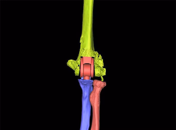 Sau 26 năm, cánh tay biến dạng lần đầu được hồi phục nhờ công nghệ 3D -0