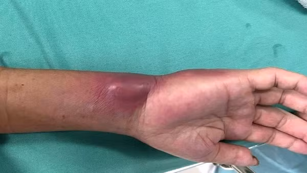 2 ca bệnh nhiễm “vi khuẩn ăn thịt người” ở Đắk Lắk sắp xuất viện
