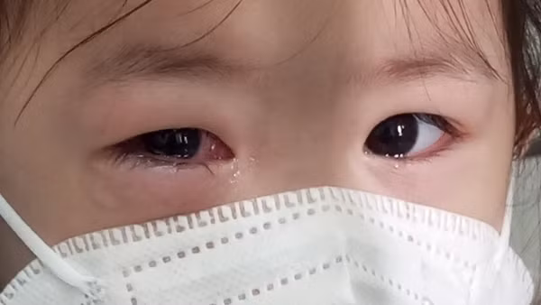 Bệnh đau mắt đỏ bùng phát mạnh, bác sĩ hướng dẫn cách điều trị
