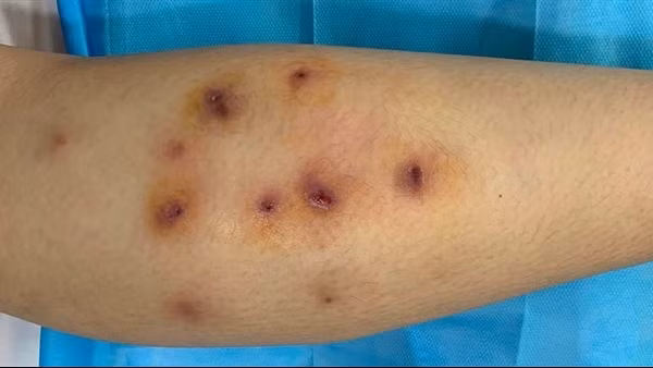 Cẩn trọng khi tiêm tan mỡ giảm béo