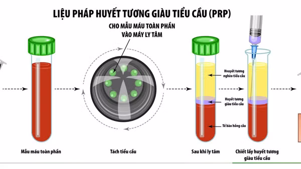 Bệnh viện 30-4 dùng huyết tương giàu tiểu cầu điều trị bệnh
