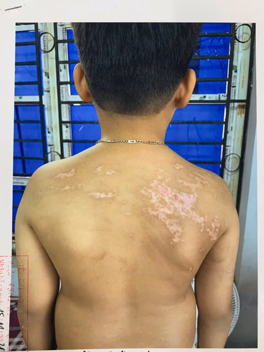 Tạm giam người bố bạo hành con trai 7 tuổi -0