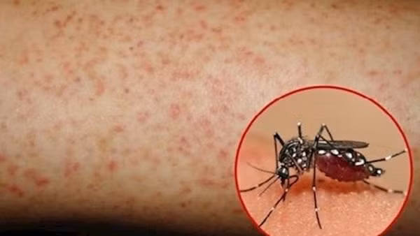 Số ca mắc sốt xuất huyết tăng vọt tại Hà Nội ảnh 3