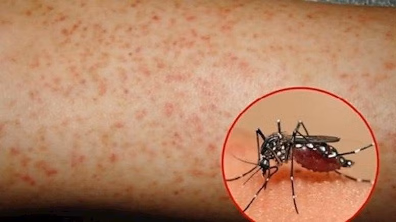 Đã có 30 ca tử vong vì sốt xuất huyết -0