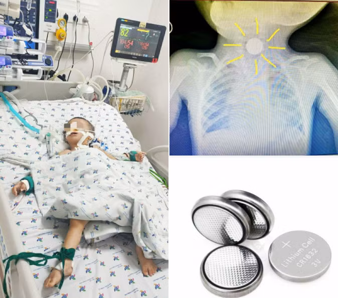 Bé trai 3 tuổi nguy kịch vì nuốt pin cúc áo -0