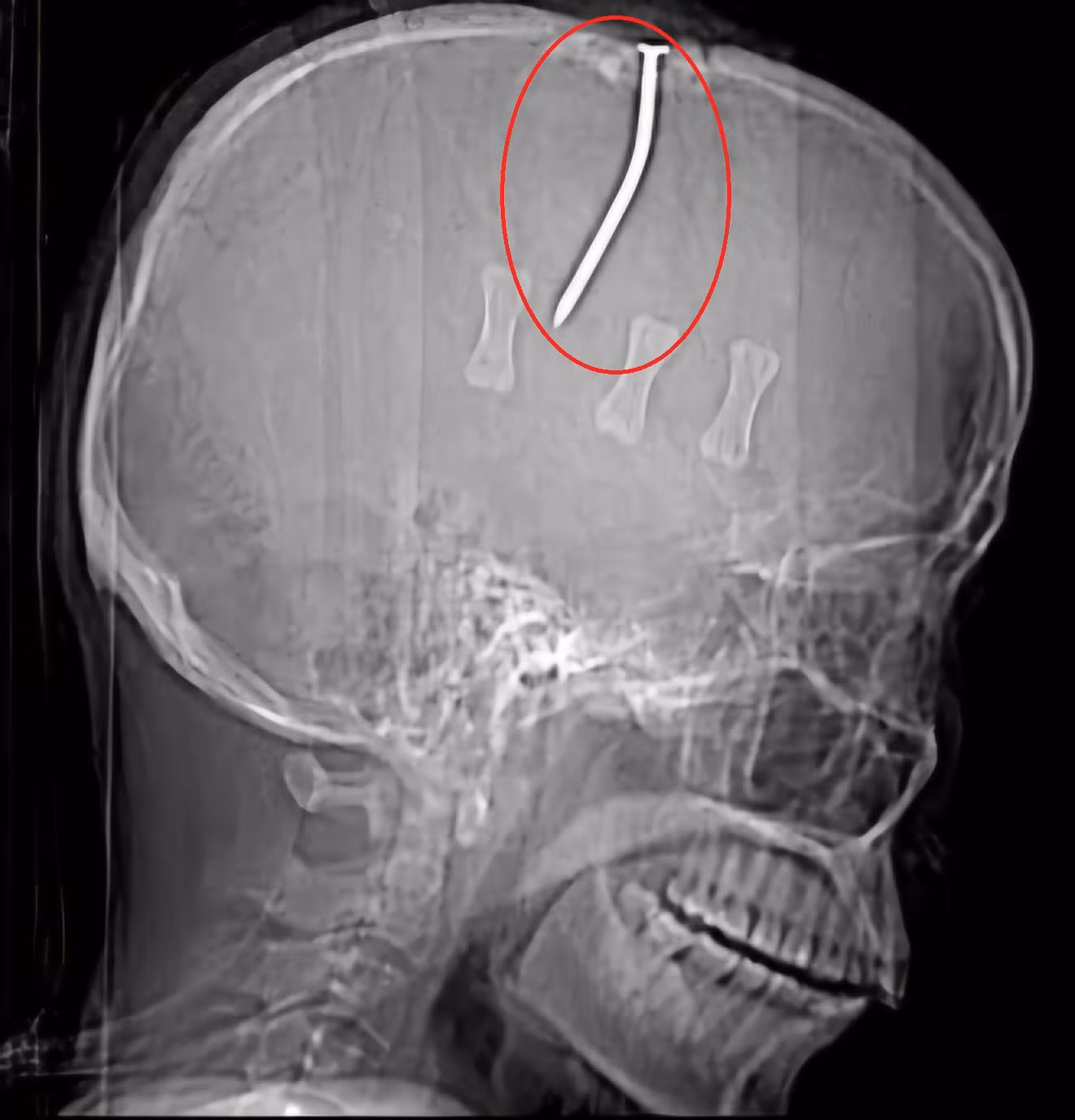 Cứu sống người đàn ông bị đóng đinh 10 cm vào đầu chưa rõ nguyên nhân -0