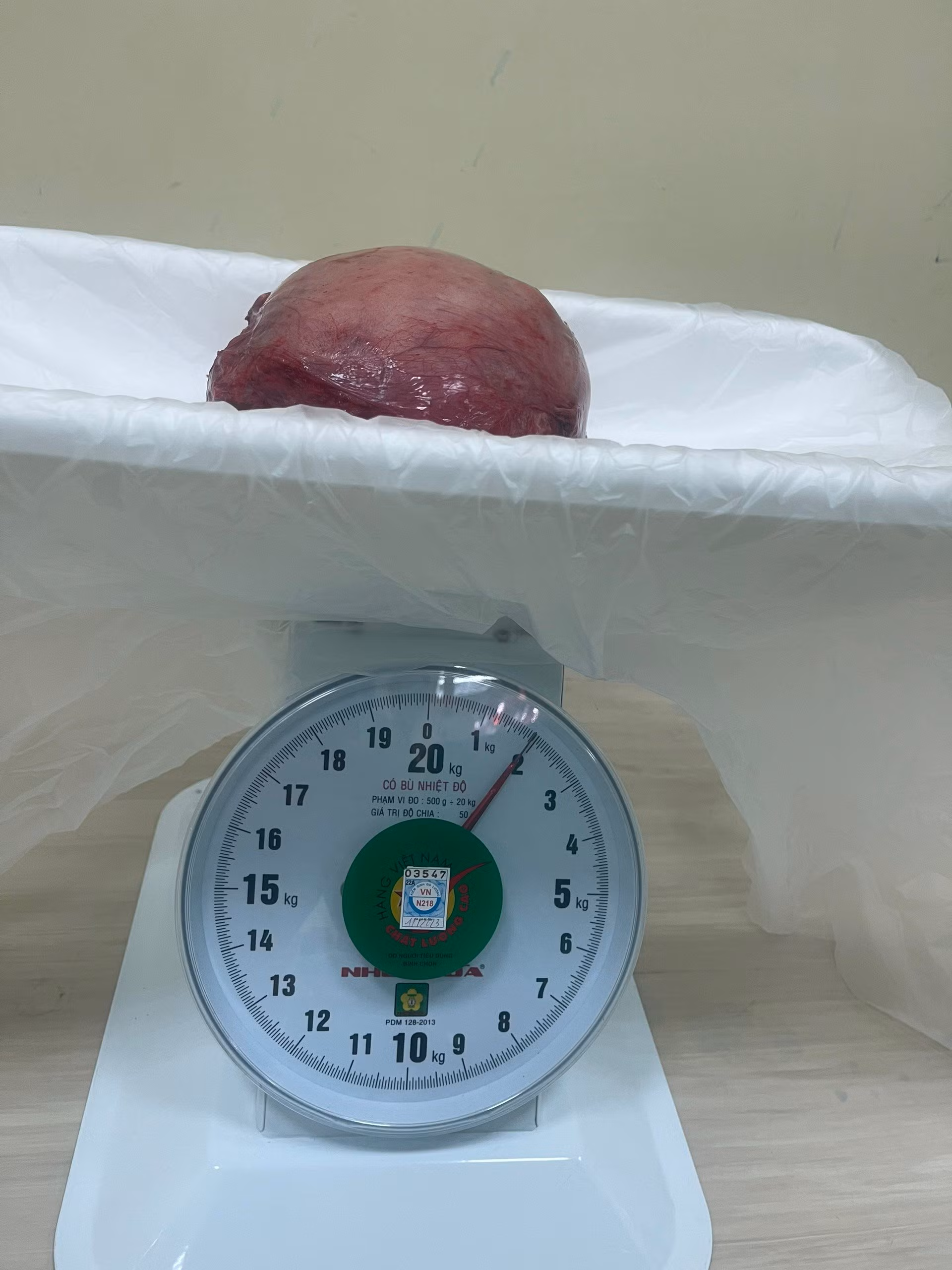 Cắt khối u xơ tử cung nặng 2kg cho nữ bệnh nhân 54 tuổi -1