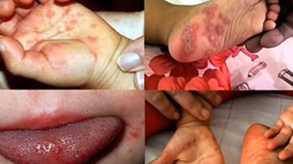Bé gái 2 tuổi ở Bến Tre tử vong do mắc bệnh tay chân miệng