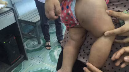 Bé gái 8 tháng tuổi nghi bị bảo mẫu đánh bầm tím 