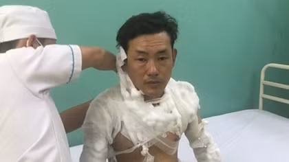 Tên cướp bị bỏng nặng sau vụ cướp chi nhánh ngân hàng bất thành