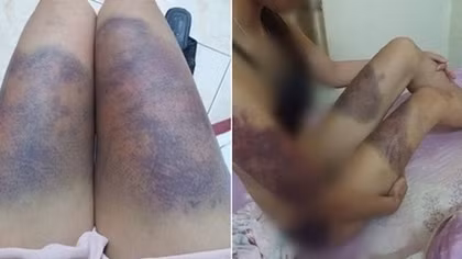 Điều tra việc cô gái tố bị người yêu hành hung dã man
