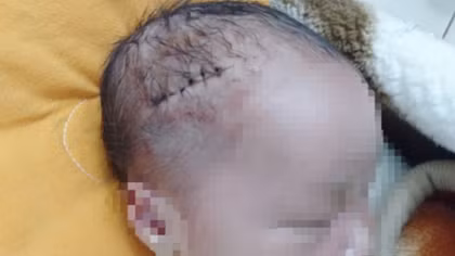 Mổ đẻ cho sản phụ, rạch trúng đầu cháu bé