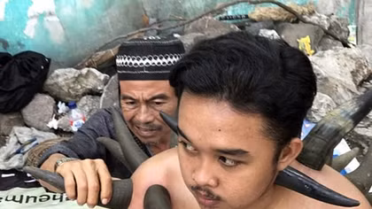 Dùng sừng trâu giác hơi chữa bệnh lan rộng ở nhiều nước