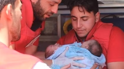 Nhói lòng cặp song sinh dính liền ra đời giữa bom rơi đạn nổ ở Syria