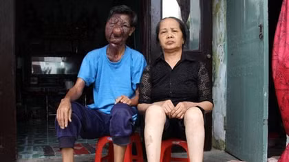 Chuyện đời buồn tủi của người đàn ông "mặt quỷ"