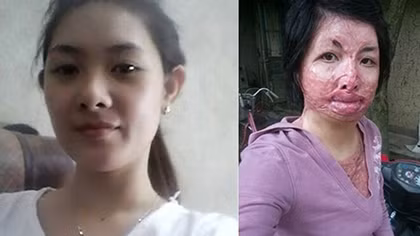 Xót xa gia cảnh người phụ nữ bị chồng tẩm xăng đốt