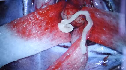 Sán nhái 7cm nằm trong não người đàn ông