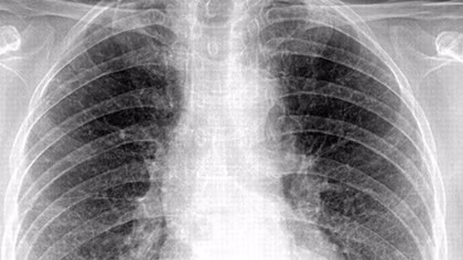 Thông tin bệnh nhân ở Tây Ninh nhiễm virus Corona là sai sự thật