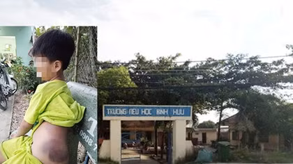 Đình chỉ công tác 15 ngày đối với giáo viên đánh học sinh lớp 1 bầm tím người