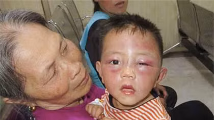 Cháu bé 2 tuổi bị bố dượng đánh đập tàn nhẫn