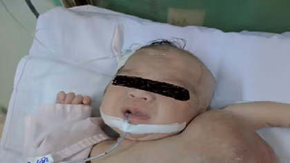 Bé gái sơ sinh có khối u khổng lồ to gần bằng cơ thể