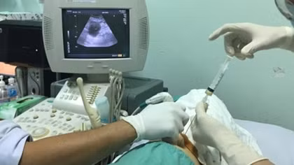 Bóc tách khối nang thận mà không cần phẫu thuật