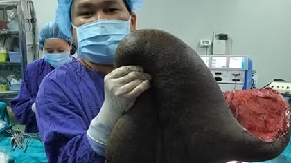 Ca mổ ngồi bóc khối u 15kg dính trên lưng người đàn ông