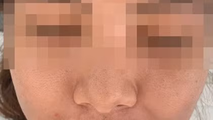 Đắp mặt nạ Đông y trắng da khiến mặt sưng phù nổi mụn