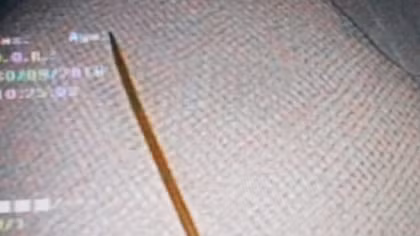 Gắp tăm tre 7cm ra khỏi dạ dày cho một bệnh nhân 
