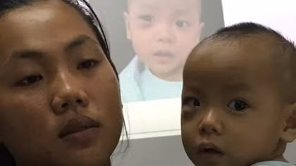 Bé trai 16 tháng tuổi suýt mù mắt vì biến chứng viêm xoang 