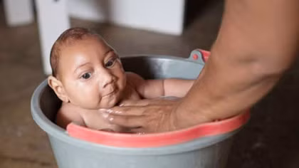 Brazil: Dịch Zika bùng nổ, ngày càng nhiều trẻ em bị dị tật bẩm sinh