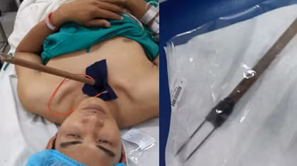 Cứu sống cán bộ dân phòng bị trộm chó bắn thủng phổi