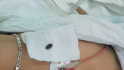 Kinh hãi "gắp" hạt dưa trong phế quản bé trai 3 tuổi 