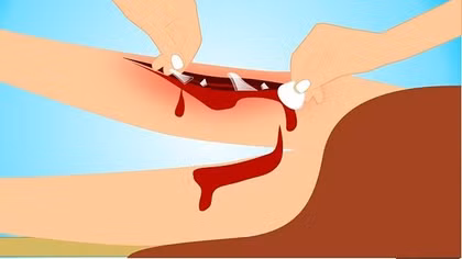 Cứu sống một bệnh nhân bị uốn ván nguy kịch